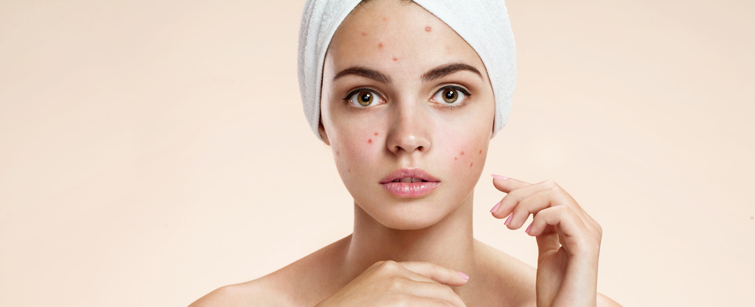 IPL Acne Solution | InVogue Med Spa